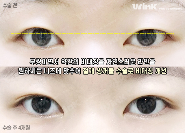 윙크성형외과는 절개쌍꺼풀 수술 후에도 빠르게 회복! 관련 이미지 9
