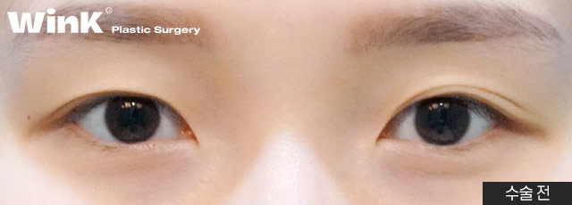 Wink canthoplasty and lower canthoplasty to overcome a cramped-looking eye shape! image 6