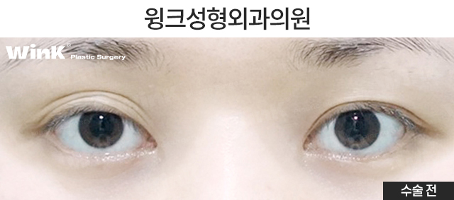 통통한 쌍꺼풀과 겹주름, 해결 방법은? 관련 이미지 5