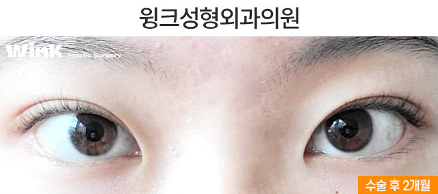 남자 속쌍커풀 수술에 대해 알아보자 관련 이미지 6