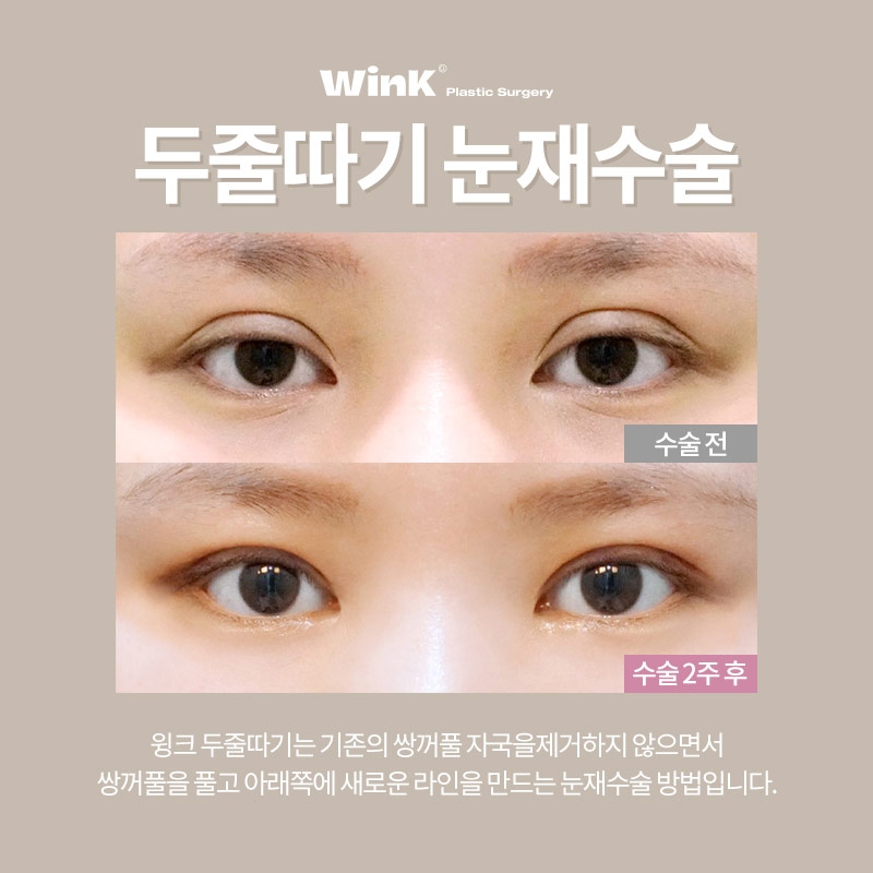 신사역쌍꺼풀재수술 알아본다면? 윙크성형외과 두줄따기눈재수술 관련 이미지 2