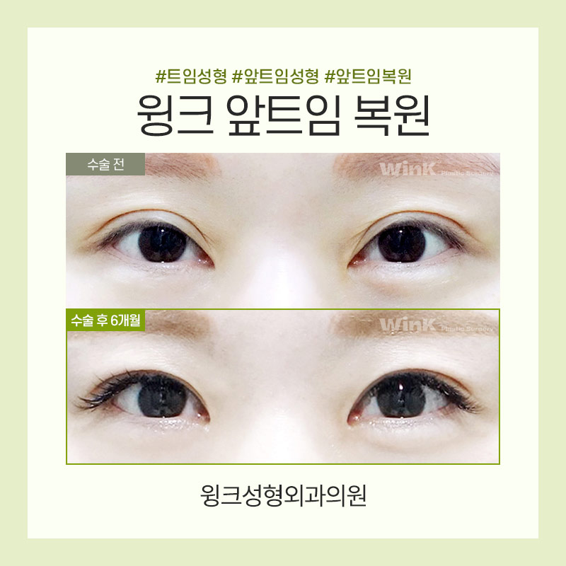 트임복원) 과도하게 트인 앞트임부작용을 앞트임복원으로 깔끔하고 자연스러운 결과 관련 이미지 4