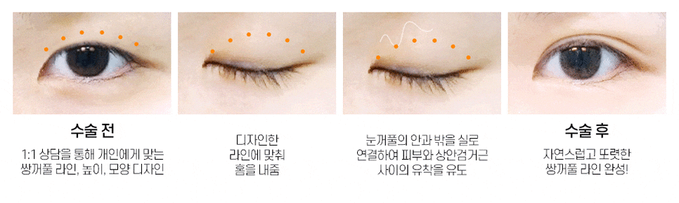 자연스럽고 잘 풀리지 않는 윙크 심플커브 자연유착 관련 이미지 2