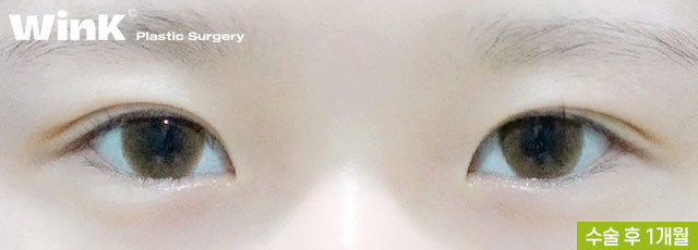 Non-incisional Eye Correction Review: A Natural, Clear Eye Shape! image 9