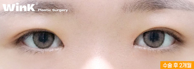 Is Fast Recovery Only Possible with Non-Incisional Surgery? At Wink Plastic Surgery, Incisional Double Eyelid Surgery Can Also Return You to Daily Life Quickly! image 9