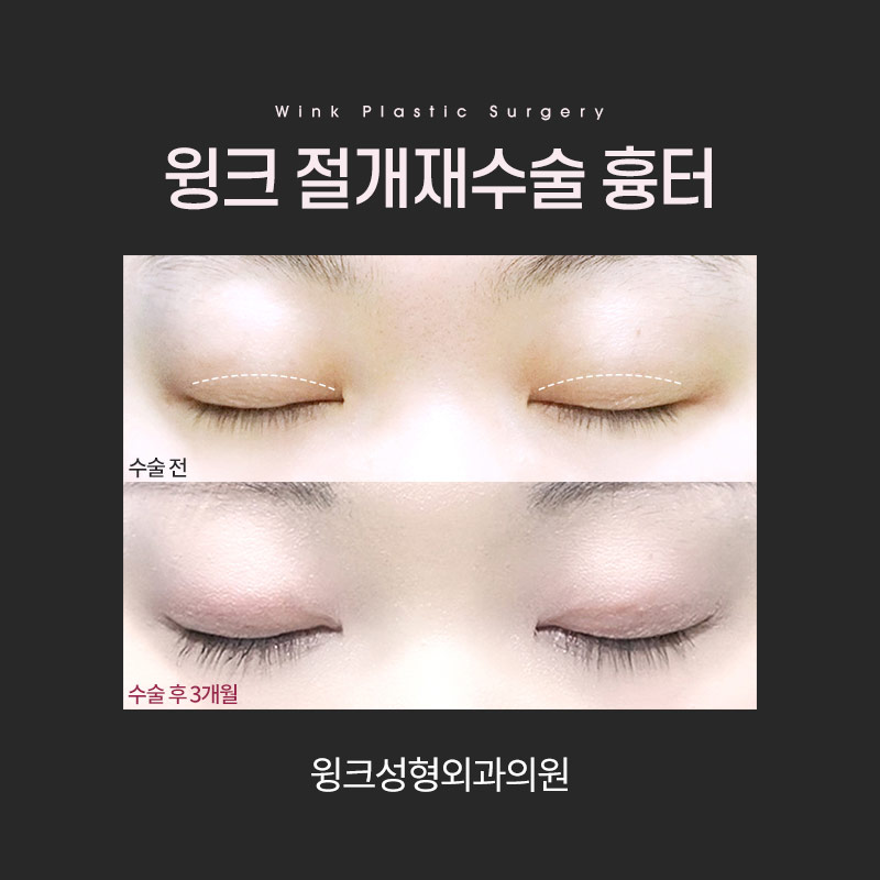 절개 쌍꺼풀 흉터에 대해 알아보겠습니다. 관련 이미지 5