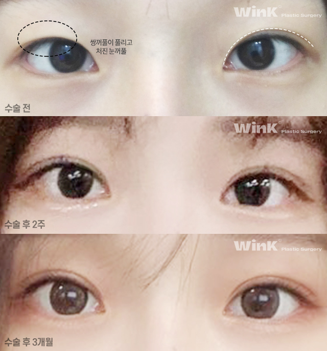 자연유착 재수술 시 주의점에 대해 알아보겠습니다. 관련 이미지 7