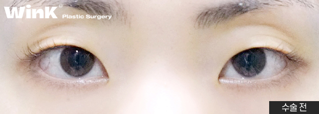 Can I Have My Eyes Surgery Done with Natural Adhesion Too? image 9