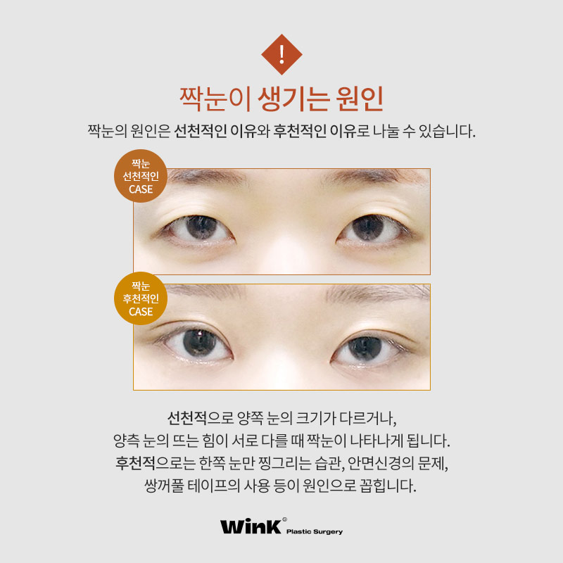 짝눈, 눈매교정으로 개선할 수 있을까? 윙크성형외과 눈매교정으로 가능해! 관련 이미지 3
