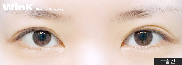 Wink’s Upper Blepharoplasty Revision Surgery, Considering Both Function and Aesthetics image 3
