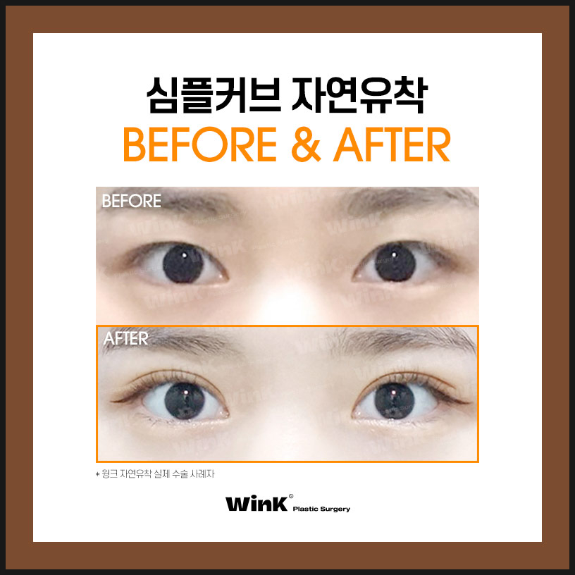 Shinsa Natural Adhesion Double Eyelid Review | Natural Adhesion Double Eyelid Surgery | Wink Plastic Surgery | Natural Adhesion Double Eyelids image 4