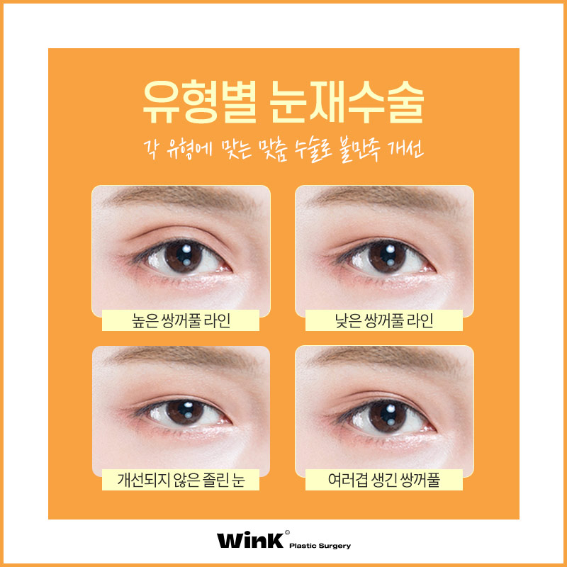 Wink’s Upper Blepharoplasty Revision Surgery, Considering Both Function and Aesthetics image 6