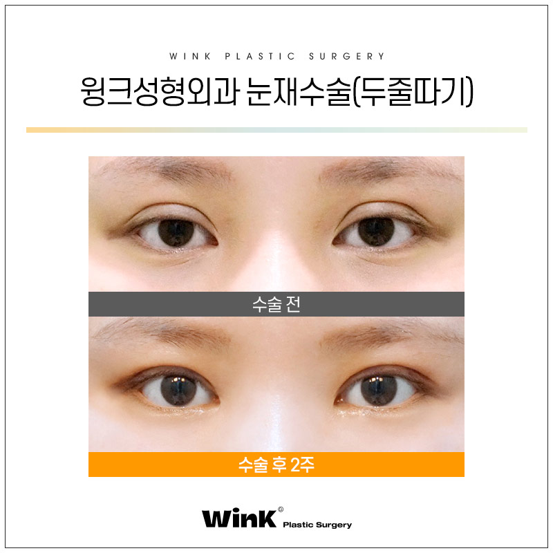 윙크성형외과에서 알려드리는 눈성형의 모든것! 관련 이미지 8