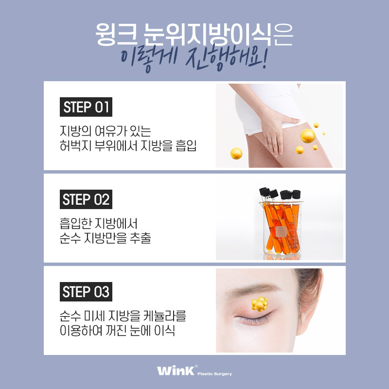 Let’s Restore Volume to Sunken Eyes with Wink Plastic Surgery’s Upper Eyelid Fat Grafting image 4