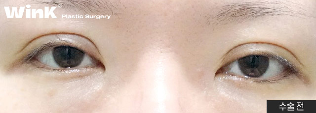 Are All Revision Eyelid Surgeries the Same? For High Crease "Sausage Eyes," Use Two-Line Technique to Lower the Front Line image 7