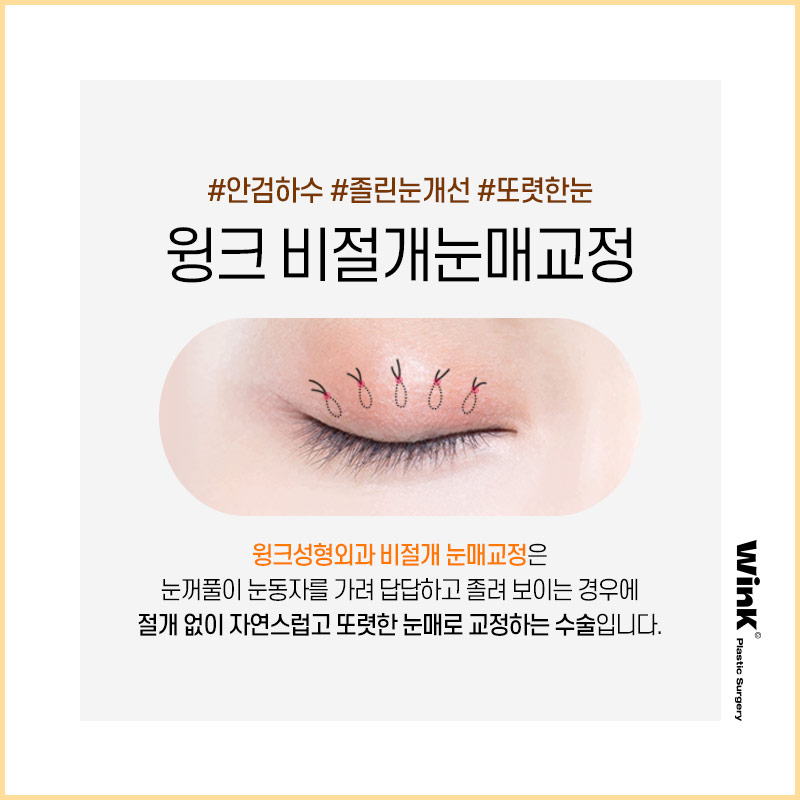 Wink Plastic Surgery’s Non-Incisional Ptosis Correction for Clearer Eyes Without an Incision! image 7