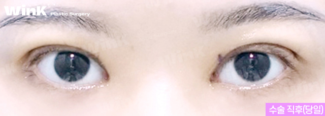 높고 깊은 고정으로 생긴 소세지눈, 윙크성형외과 두줄따기로 라인낮추기! 관련 이미지 3