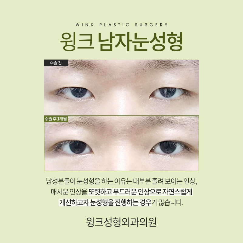 Male Eye Surgery: How Is It Best Done? image 2