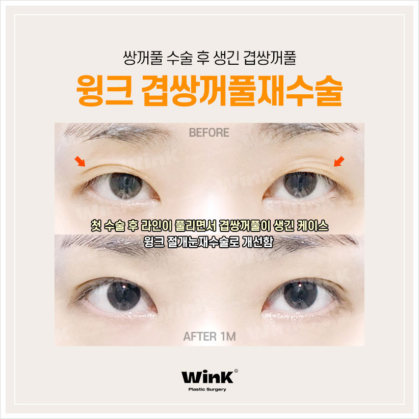 Multiple Eyelids, Double Eyelid Creases, Double Folded Eyelids, Eyelid Creases, Wink Plastic Surgery, Double Eyelids, Double Eyelid Revision Cost image 3