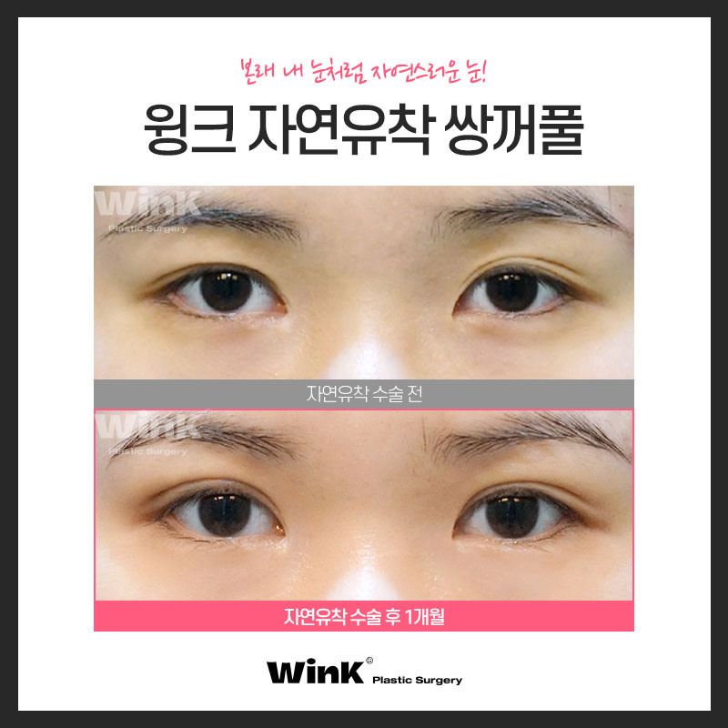 윙크성형외과 자연유착쌍꺼풀후기 쌍수잘하는곳 관련 이미지 5