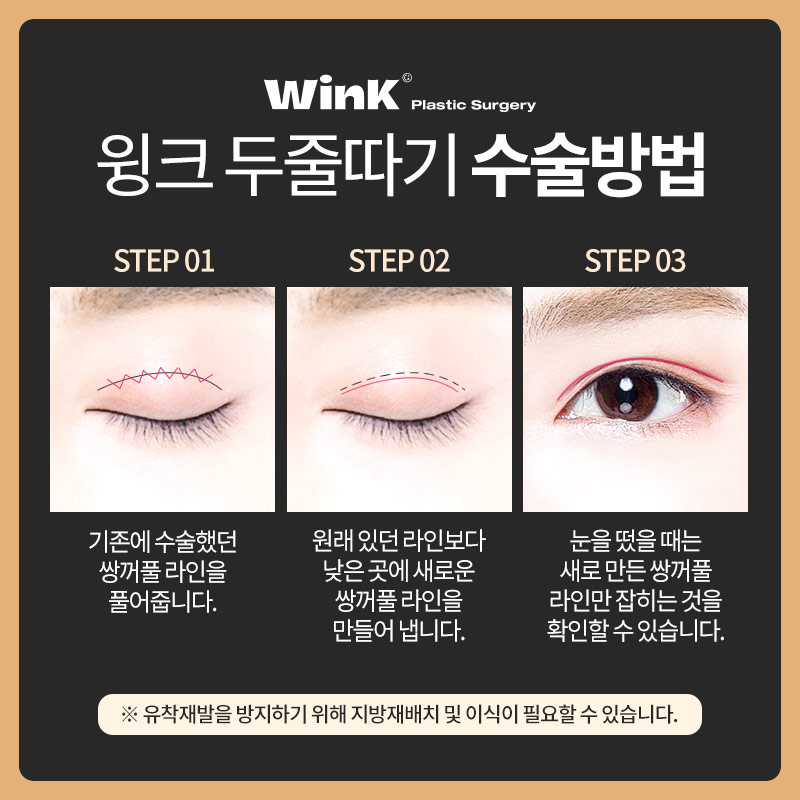 Shinsa Station Eye Revision Surgery: Lowering the Fold Line with the Double-Line Method image 3
