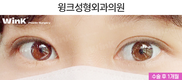 If You’re Looking Into Revision Double Eyelid Surgery, Visit Wink Plastic Surgery for Beauty and Function! image 6