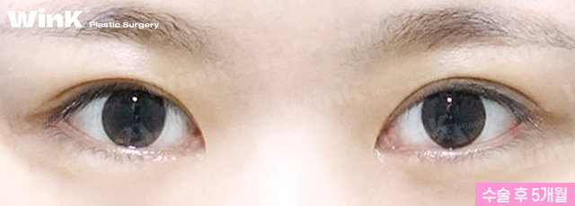 두줄따기 눈재수술로 수술 직후에도 자연스럽게! 관련 이미지 7