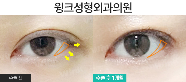 뒷밑트임으로 눈의 숨겨진 공간을 찾자! 윙크 듀얼트임 관련 이미지 7