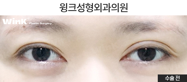 두줄따기 절개 눈재수술로 소세지눈에서 벗어나 볼까요? 관련 이미지 5