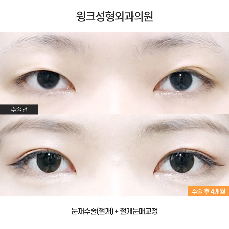 통통한 쌍꺼풀과 겹주름, 해결 방법은? 관련 이미지 1