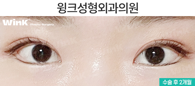 뒷밑트임으로 눈의 숨겨진 공간을 찾자! 윙크 듀얼트임 관련 이미지 3