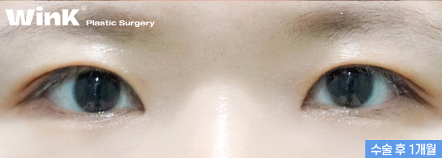 높은 쌍꺼풀 라인, 겹쌍꺼풀과 같은 유형의 눈재수술 방법은? 관련 이미지 10