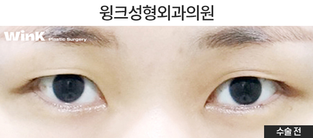 I Would Like to Talk About Natural Adhesion Double Eyelid Surgery. image 5