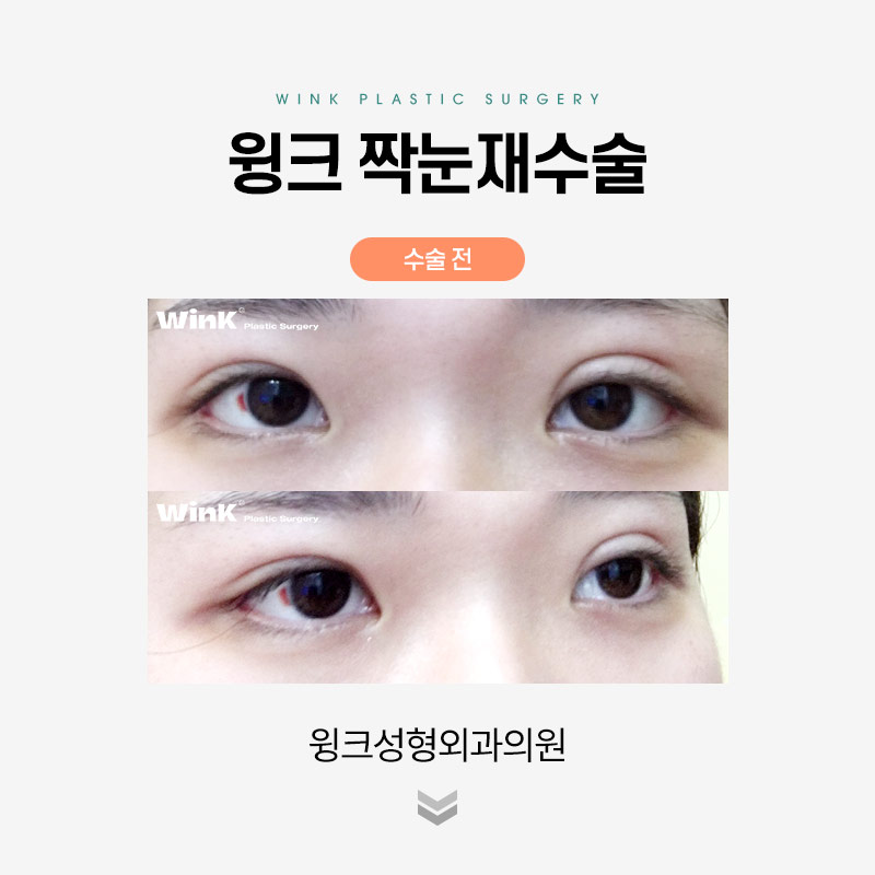 짝눈 쌍꺼풀 재수술에 관해 알아보겠습니다. 관련 이미지 3
