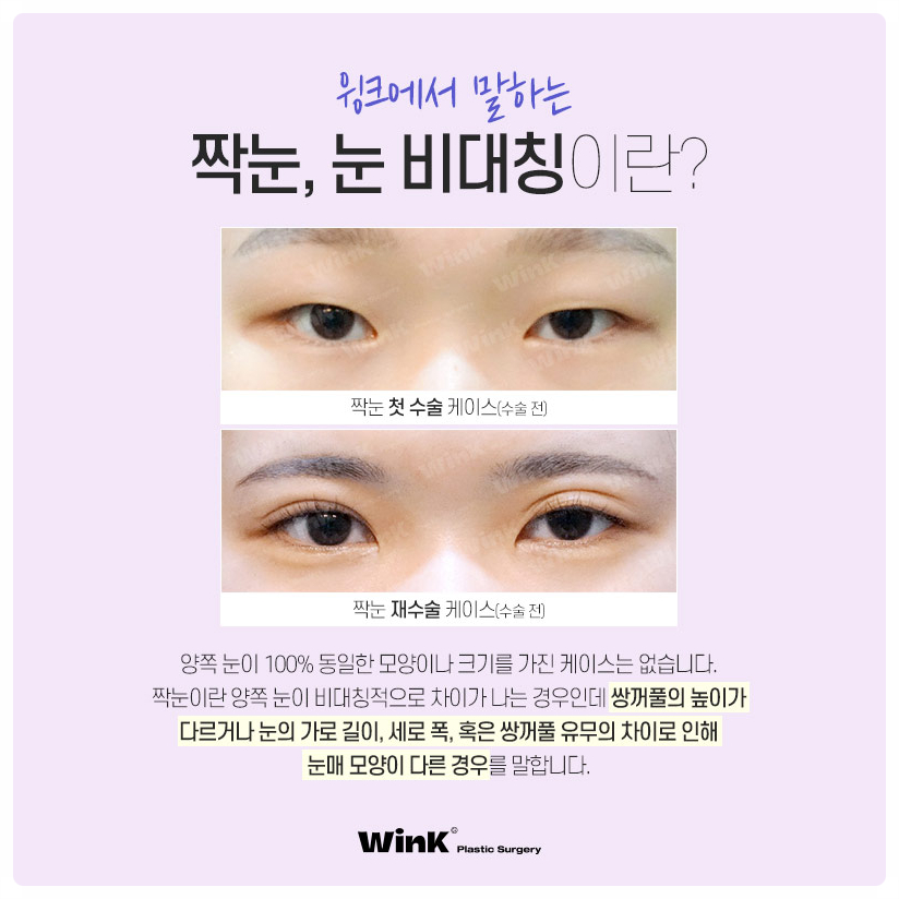If You’re Looking Into Uneven Eye Correction Reviews: Wink Plastic Surgery, Uneven Eye Correction, Uneven Double Eyelid Surgery, Uneven Eyes image 2