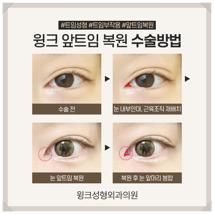 Recovery Period After Epicanthoplasty Restoration, Epicanthoplasty Scar, If You’re Only Looking Into Epicanthoplasty, Wink Plastic Surgery image 5