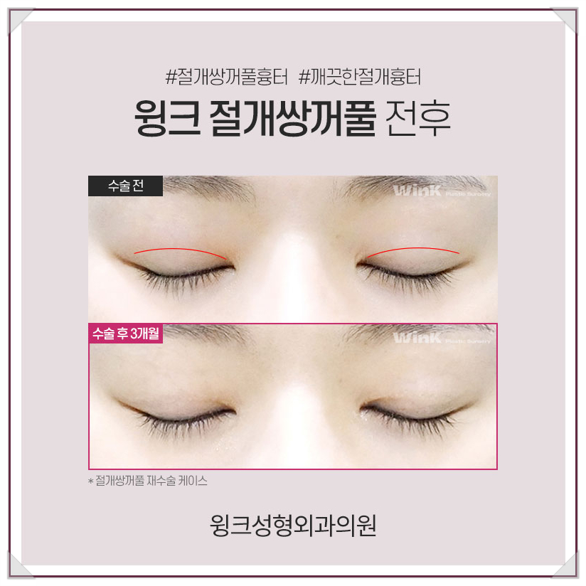 Incisional Double Eyelid Surgery: A Natural Line Without Worrying About Scars Even After Surgery! image 4