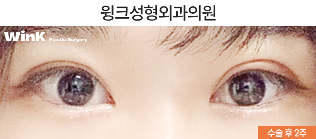 Is It Okay to Have Double Eyelid Surgery on Only One Side? image 4