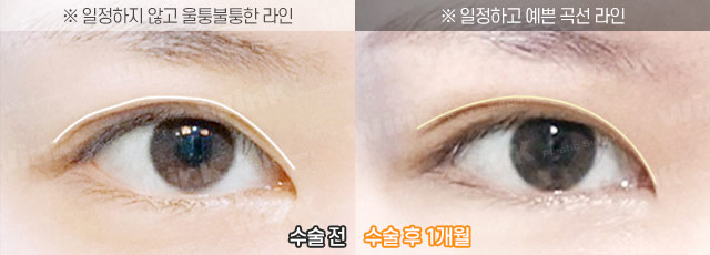 Wink’s Upper Blepharoplasty Revision Surgery, Considering Both Function and Aesthetics image 5