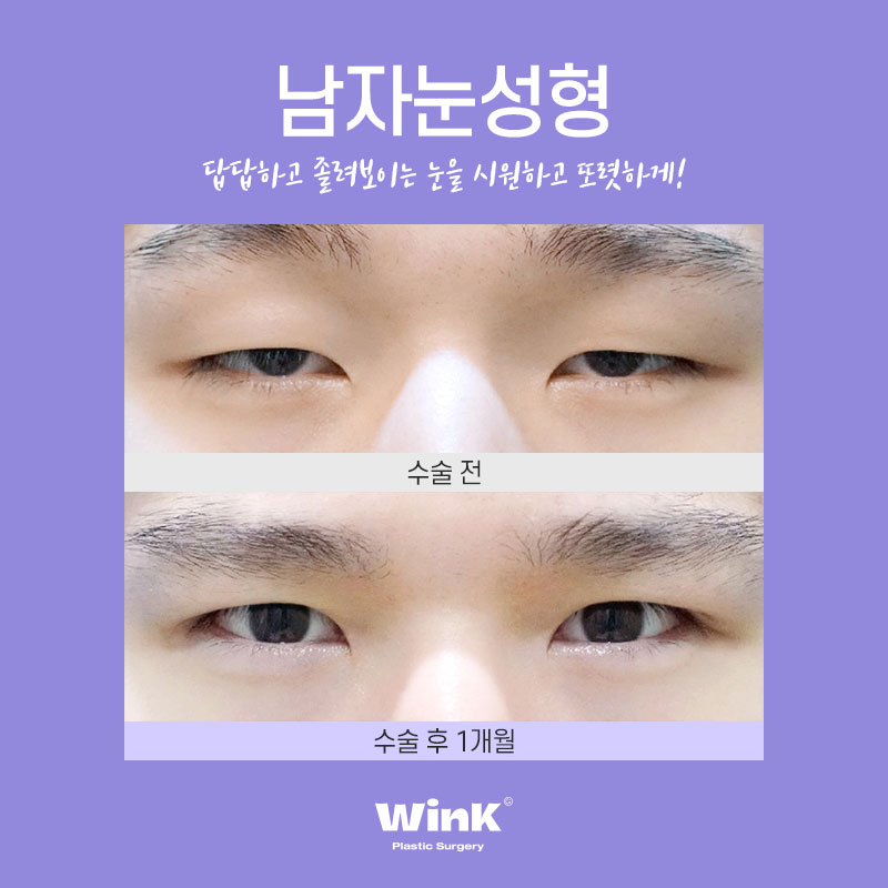 Men’s Eye Surgery: Won’t It Feel Too Much? With WINK Plastic Surgery, for a Natural and Defined Line! image 3