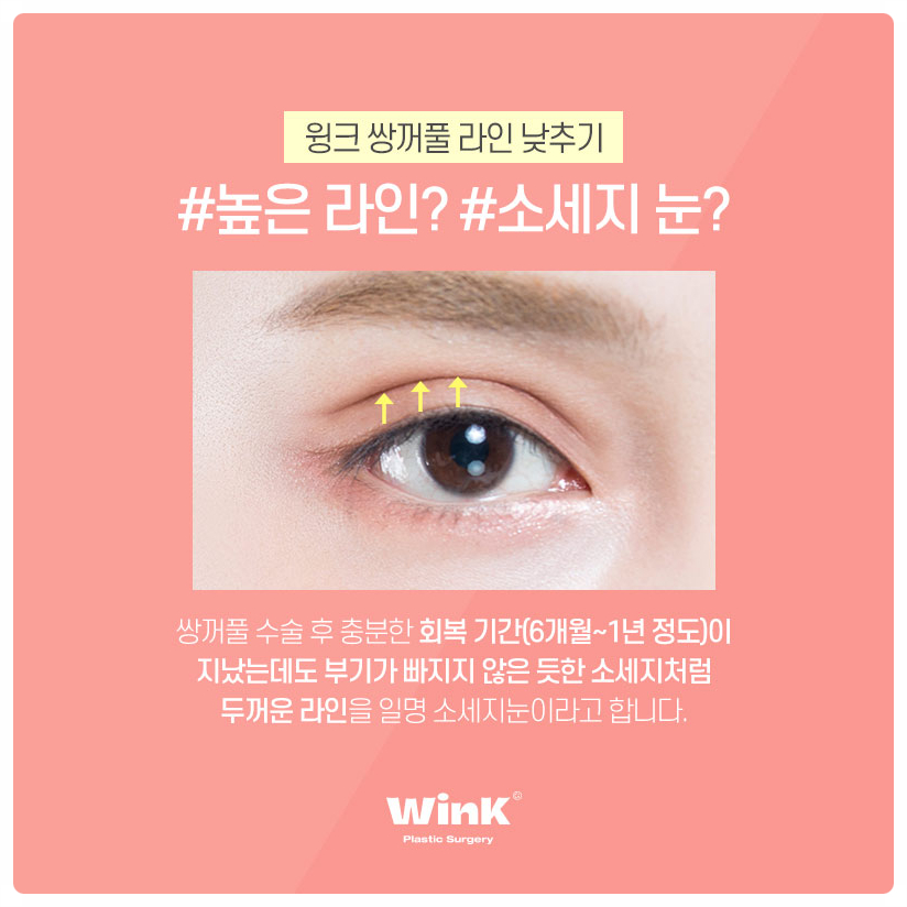 소세지눈재수술 서울눈재수술 눈재수술병원 알아본다면 윙크성형외과 관련 이미지 2