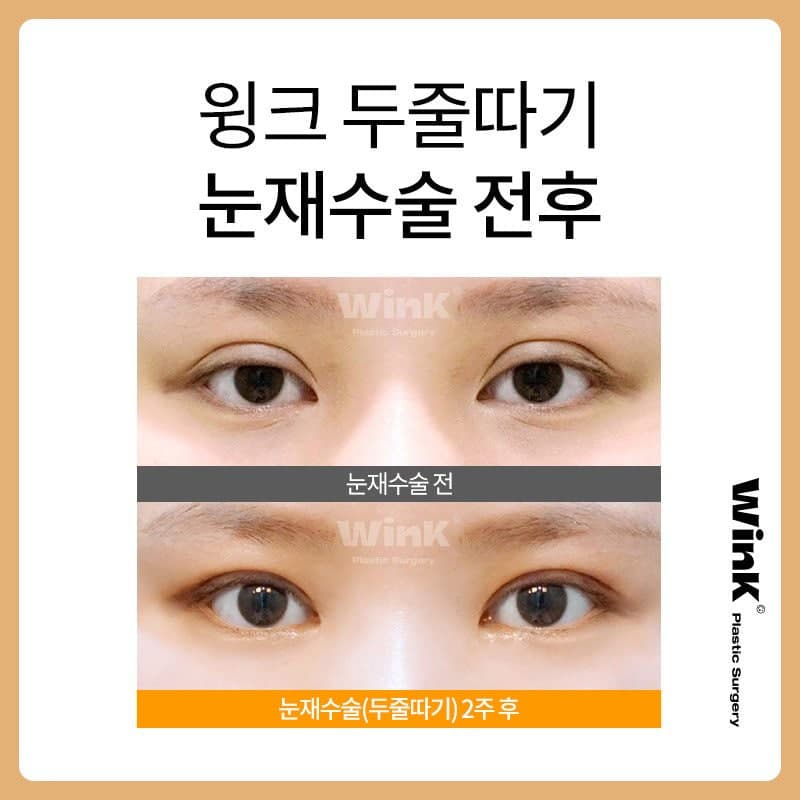 Shinsa Station Eye Revision Surgery: Lowering the Fold Line with the Double-Line Method image 6