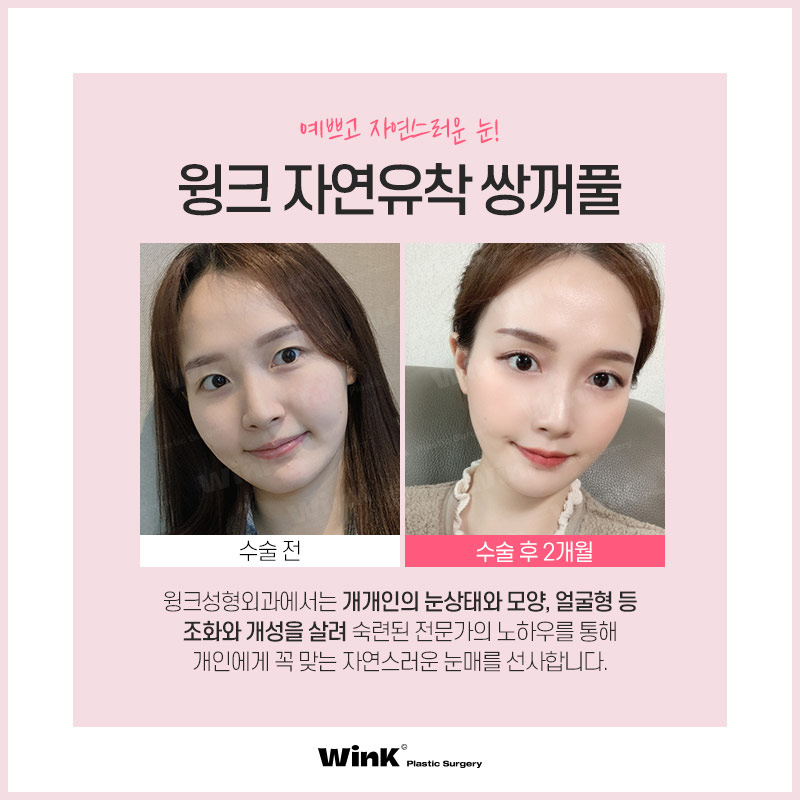 Fast Return to Daily Life and Natural Lines with Wink Natural Adhesion! image 7