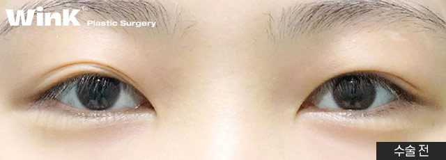 다 같은 라인? 윙크성형외과 심플커브 자연유착은 나에게 꼭 맞는 라인으로! 관련 이미지 8