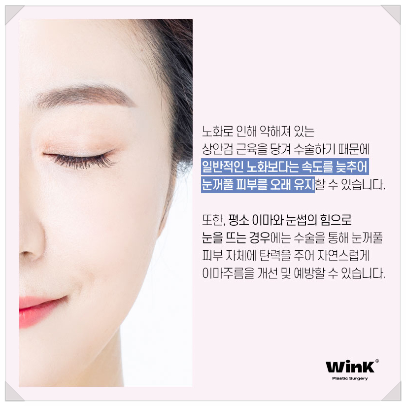 처진눈꺼풀수술 눈처짐수술 알아본다면 윙크성형외과 상안검수술 상안검수술회복기간 관련 이미지 7