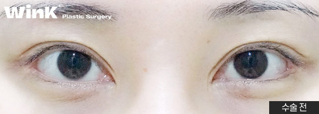 Wink Plastic Surgery Double Eyelid Revision Surgery, Pursuing Natural Results by Identifying the Exact Cause of Failure image 9