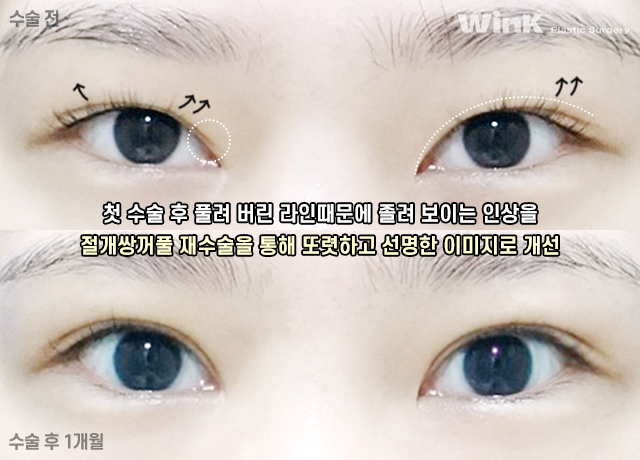 꼬막눈 쌍수도 시원하게! 눈성형 중점 진료 윙크성형외과 관련 이미지 4