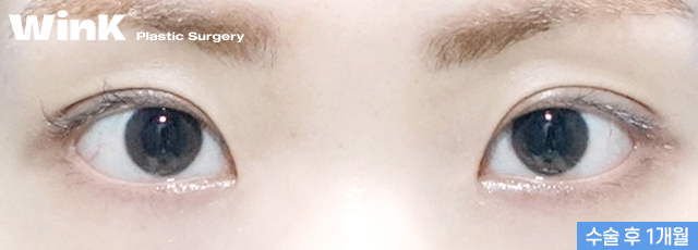 Can I Have My Eyes Surgery Done with Natural Adhesion Too? image 10