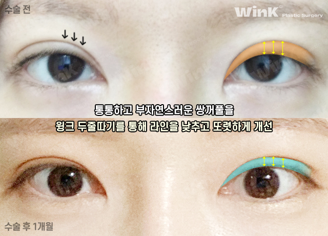 소세지눈 재수술, 두줄따기로 라인 낮추기 관련 이미지 6
