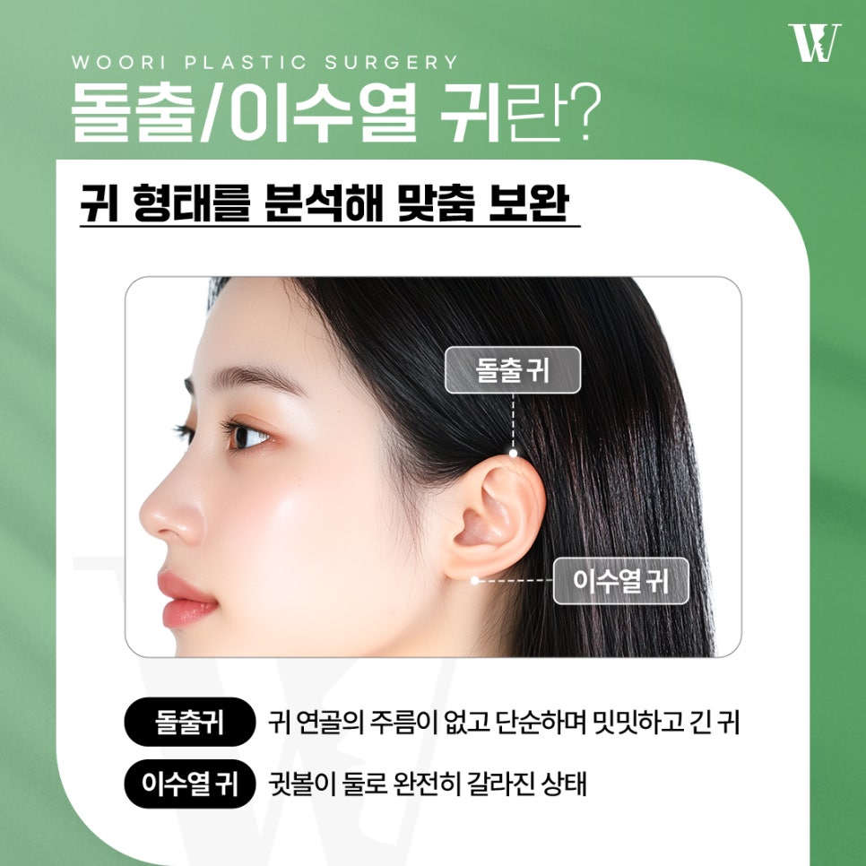 귀성형 돌출귀 교정이 고민될 때 관련 이미지 2